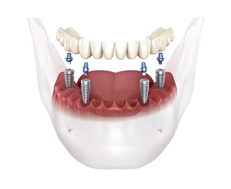 implant images